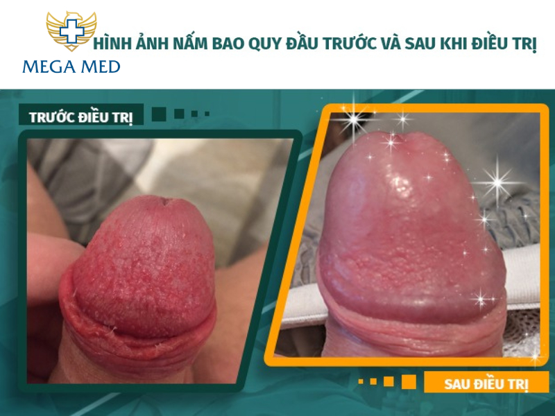 Hình ảnh trước và sau khi điều trị nấm bao quy đầu